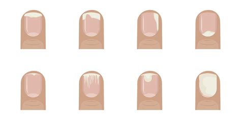 Nail Separating From Nail Bed