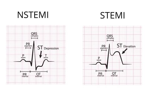 Nstemi Ekg