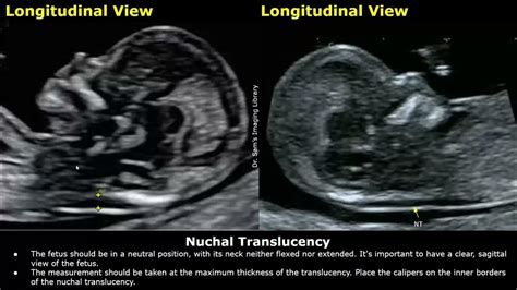 Nt Screening Test