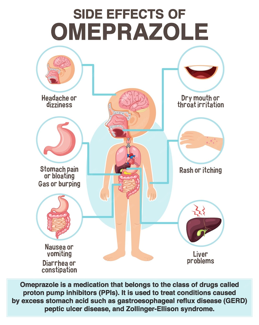 Omeprazole Does It Help Bloating