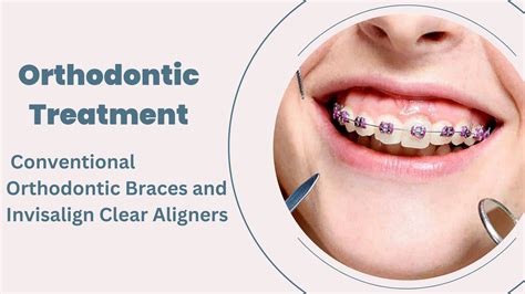 Best Orthodontic Treatment Reviews Uncovered!