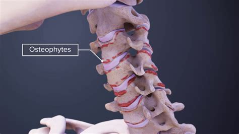 Osteophytes In Cervical Vertebrae
