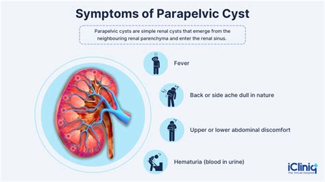 Parapelvic Renal Cysts Explained: Silent Kidney Health Concern Revealed