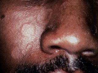 Petaloid Seborrheic Dermatitis
