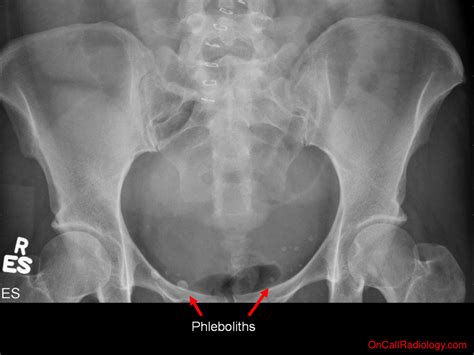 Phleboliths In Pelvis