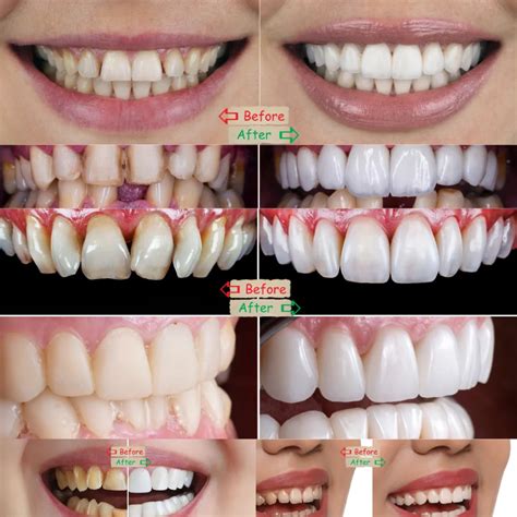 Unveiling Porcelain Veneers Cost in Dubai: What You Need to Know