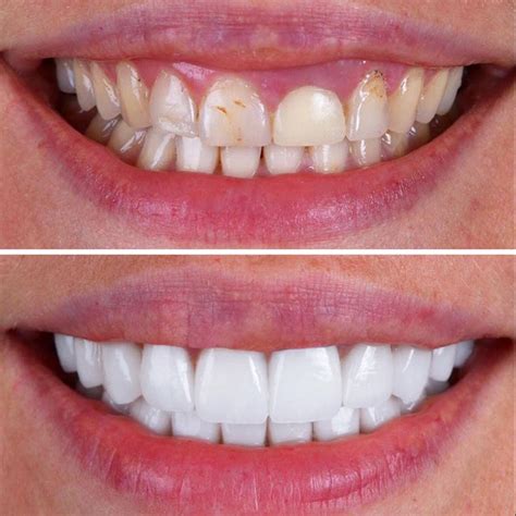 Best Porcelain Veneers UK: Transform Smiles Today