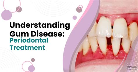 Professional Treatment for Gum Disease: Restore Your Smile Today