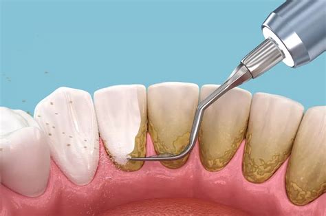Best Professional Treatment for Tartar Removal Revealed