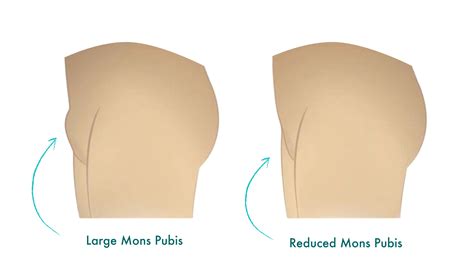 Pubis Mound Removed