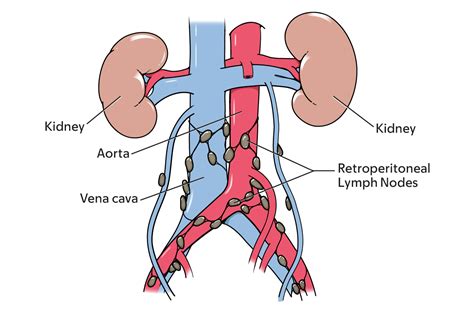 Retroperitoneal Lymph Nodes