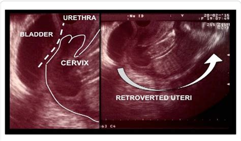 Retroverted Uterus Does It Affect Pregnancy
