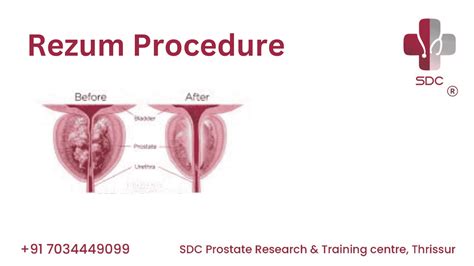 Rezum Prostate Procedure