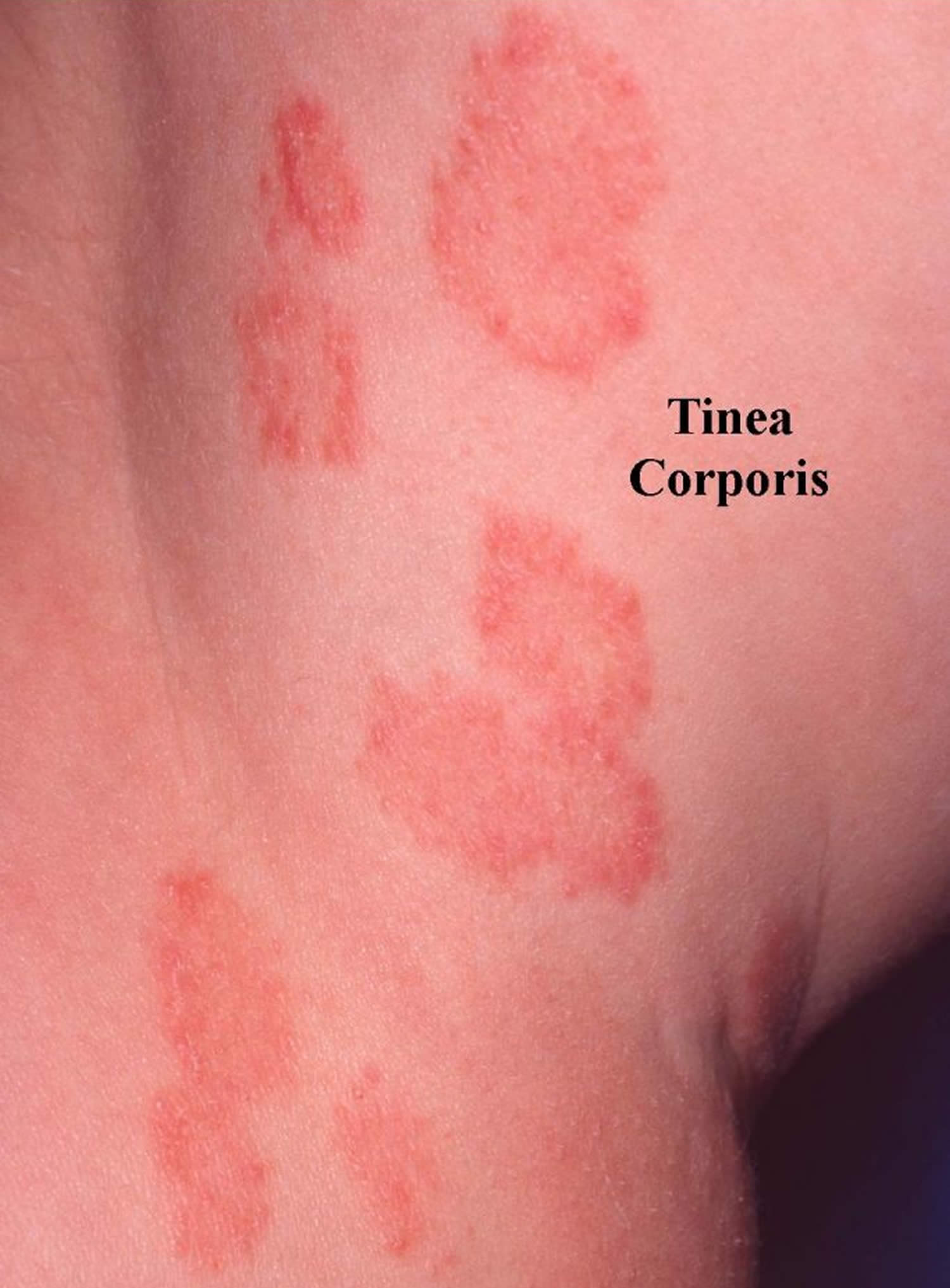 Ringworm Healing Stages
