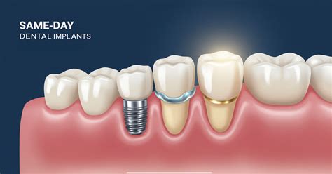 Instant Same Day Dental Implants in Canada