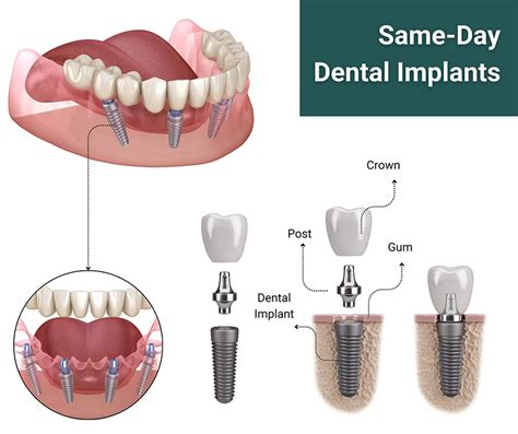Get Same Day Dental Implants with Same Day Appointments Today