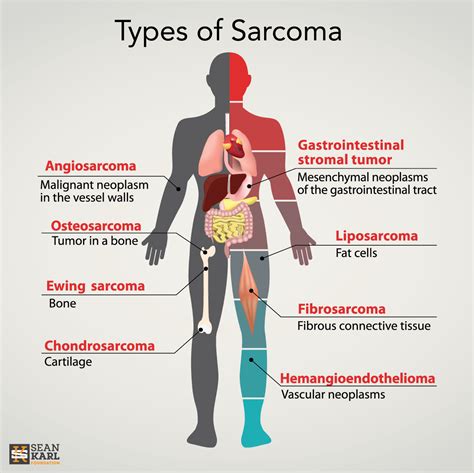 Sarcoma Cancer Symptoms
