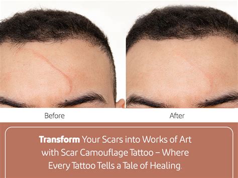 Scar Camouflage Tattoo