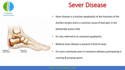Sever's Disease Treatment