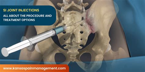 Si Joint Injection
