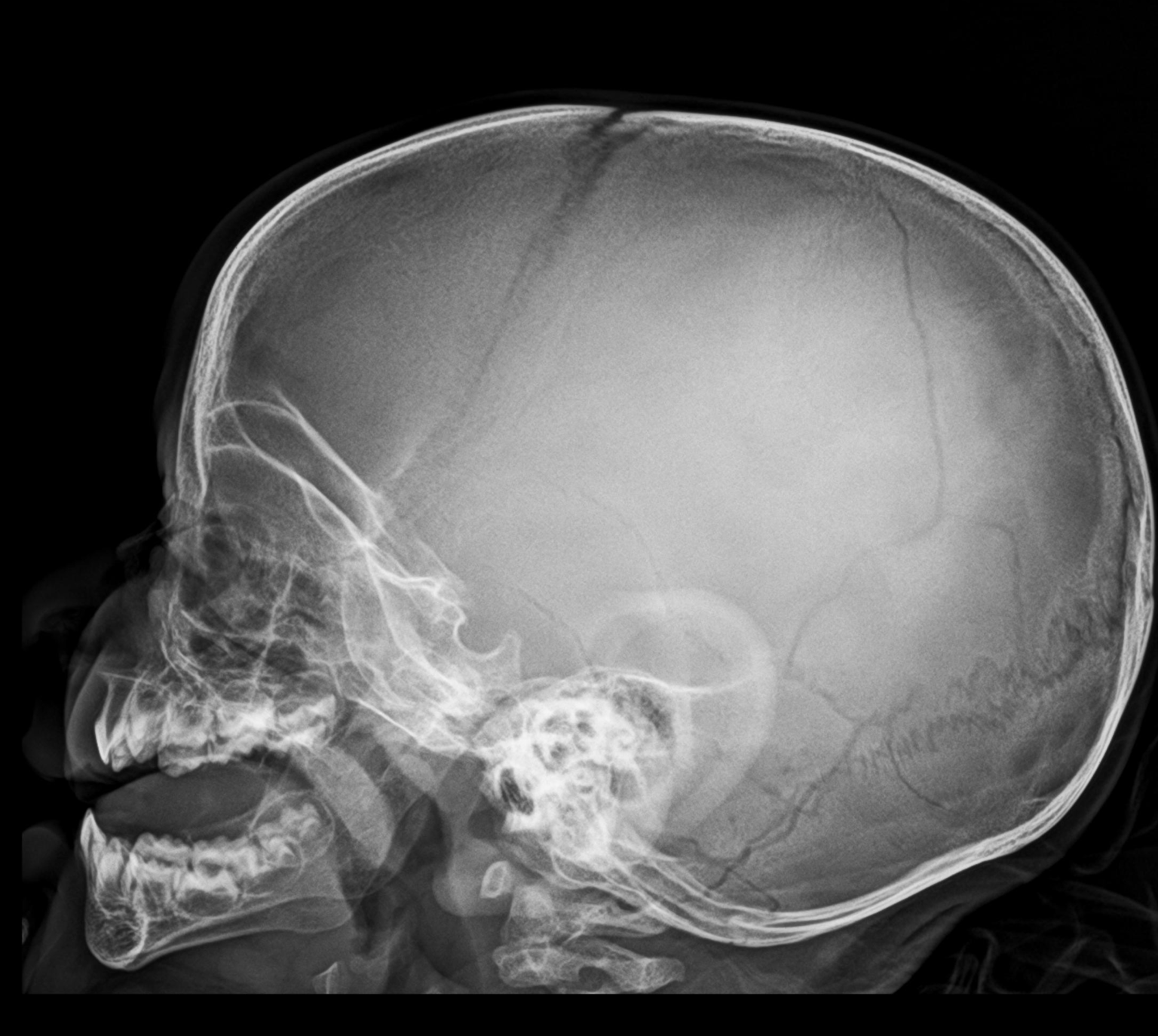Skull Posterior Fossa