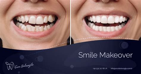 Smile Makeover Cost: USA Secrets Revealed