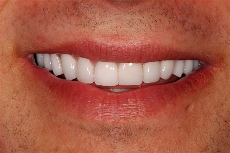 Smile Makeover Payment Plan: Affordable Smiles Without Breaking the Bank