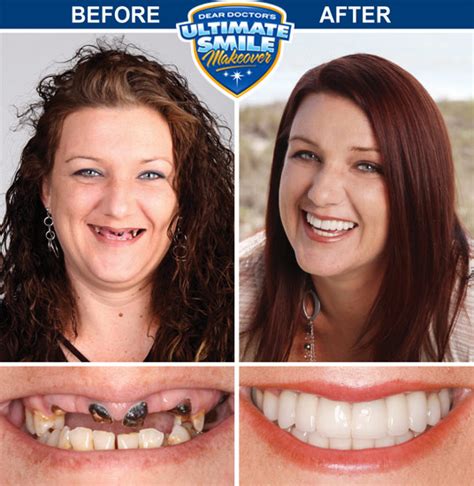 Amazing Smile Makeover Results Unveiled!