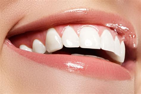 Same Day Smile Makeover Appointment Available!