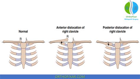 Sternoclavicular Joint Dislocation