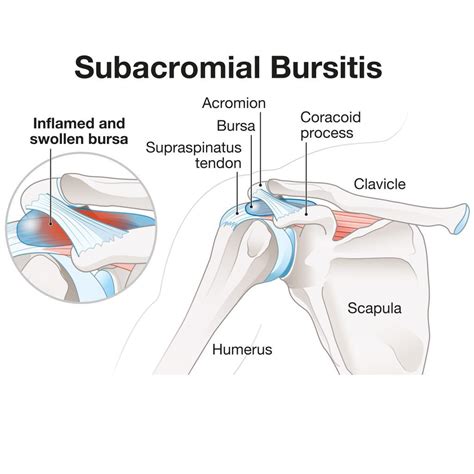 Subacromial Subdeltoid Bursitis