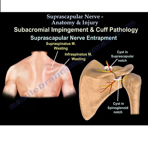 Suprascapular Nerve Notch