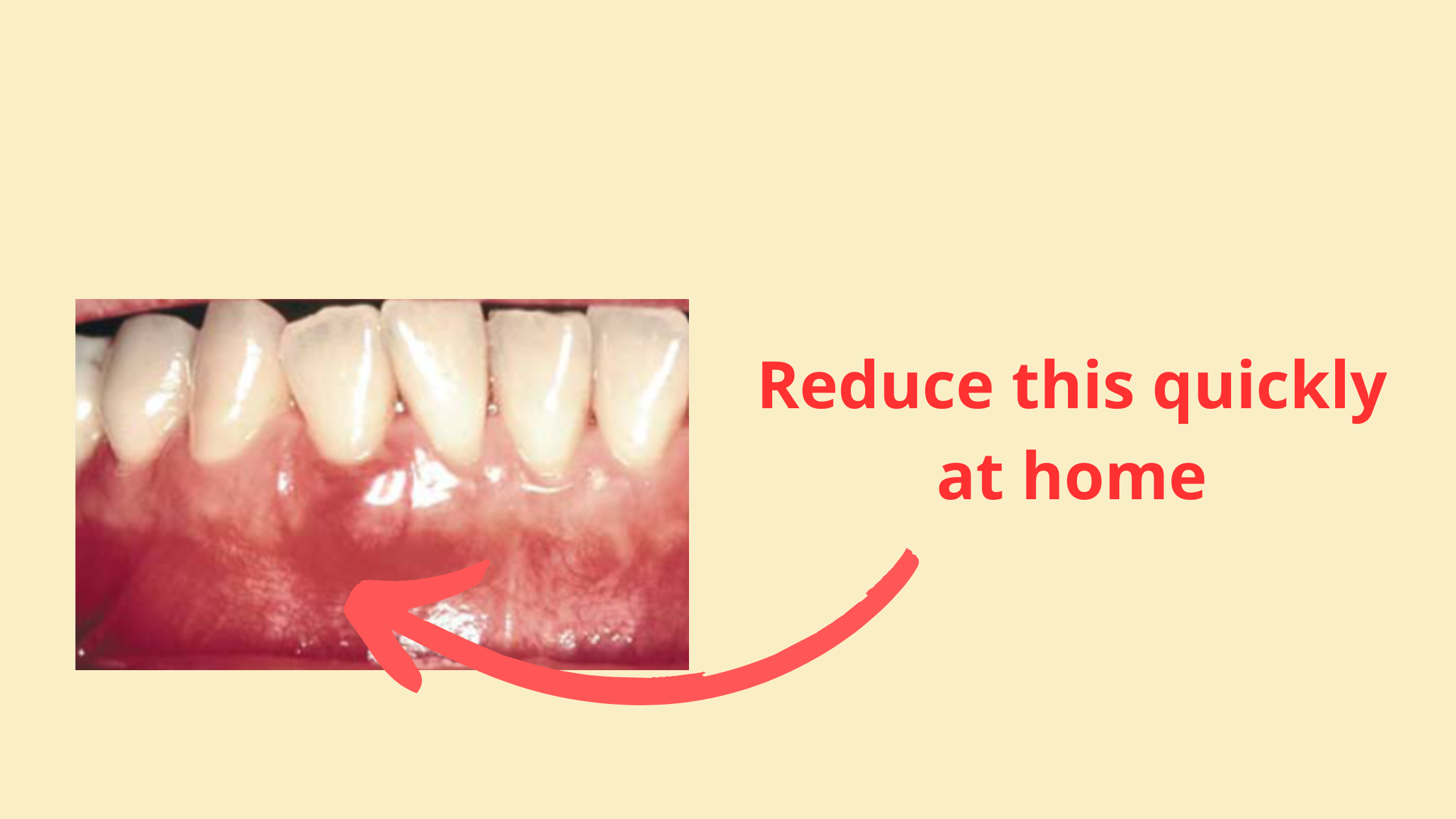 Swollen Uvula From Snoring