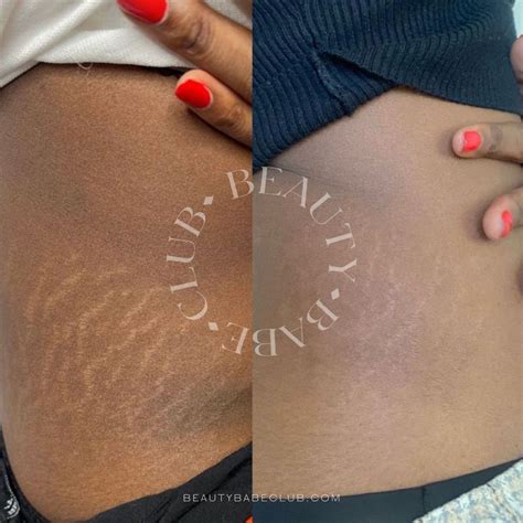 Tattooing Over Stretch Marks Before And After