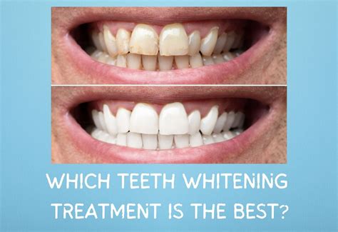 Top Advantages of Teeth Whitening Treatment for a Brighter Smile