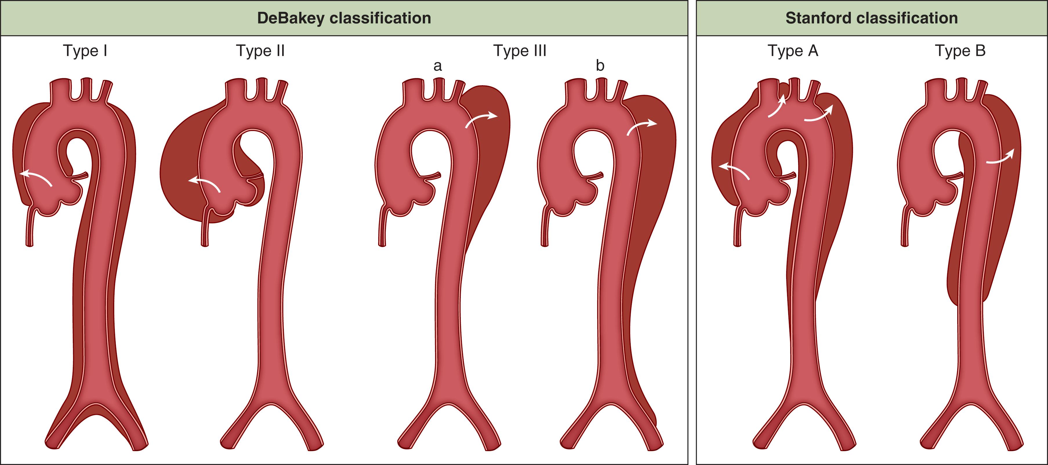 Thoracic Back Pain