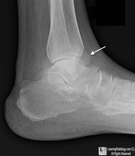 Tibiotalar Joint Effusion