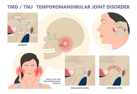 Tmj/Tmd And Headaches