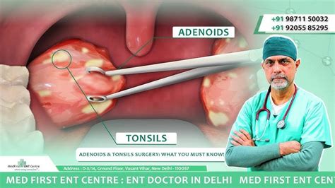 Tonsil And Adenoid Removal
