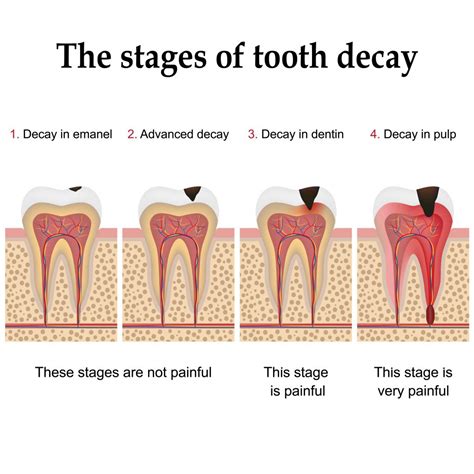 Stop Tooth Decay: Simple Step-by-Step Guide