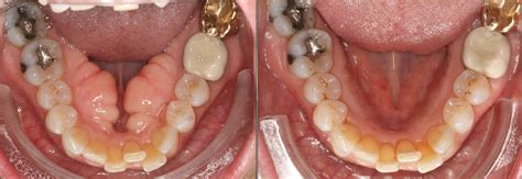 Torus Mandibularis Removal