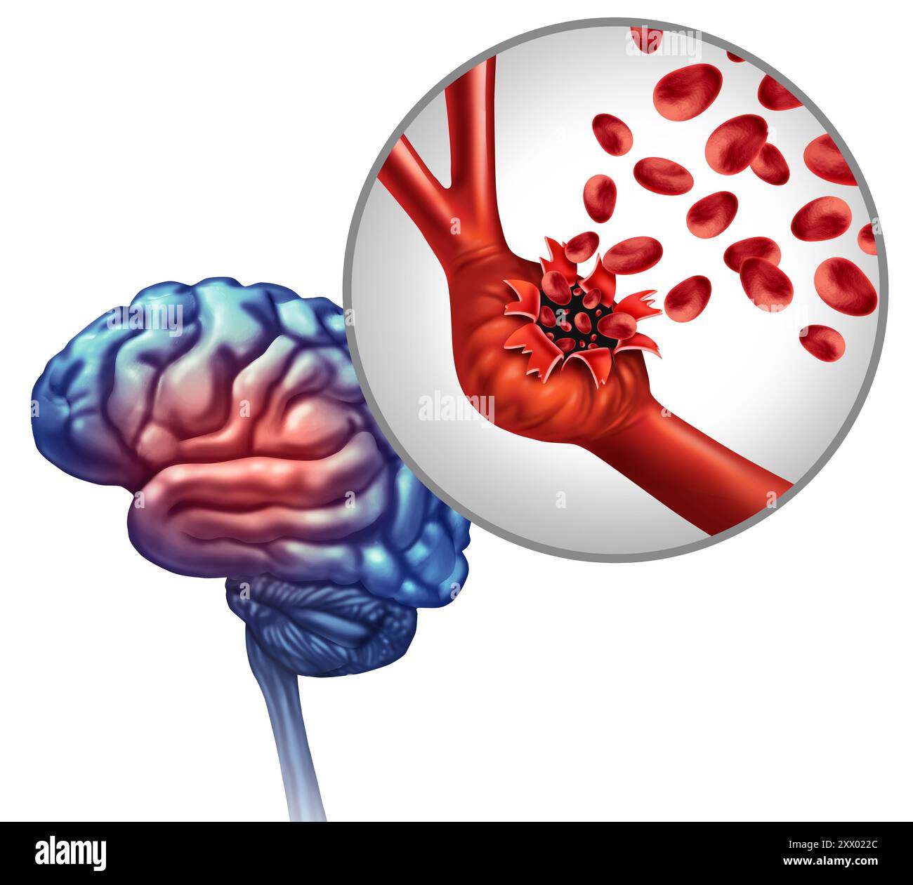 Understanding Rare Brain Ulcers: Symptoms And Treatments A Brain Lesion Is It Could Your Leaking Blood Vessel Cause One Trapped Infection Causes And Treatment What Keeps You Awake Popping Up In Your Skull
