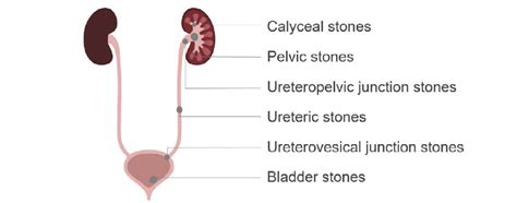 Ureterovesical Junction Stone