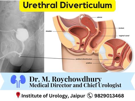 Uncovering the Mysteries of Urethral Diverticulum: Rare But Significant Condition