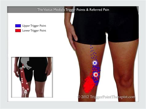 Vastus Medialis Pain Relief Guide