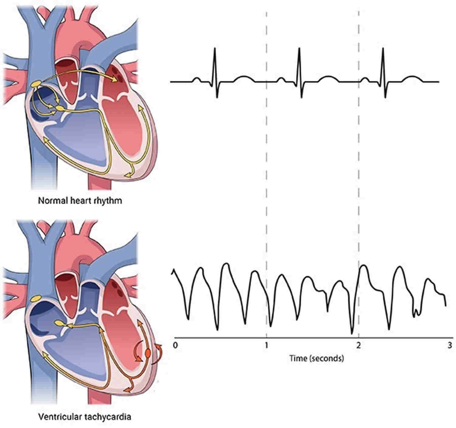 Ventricular Rate