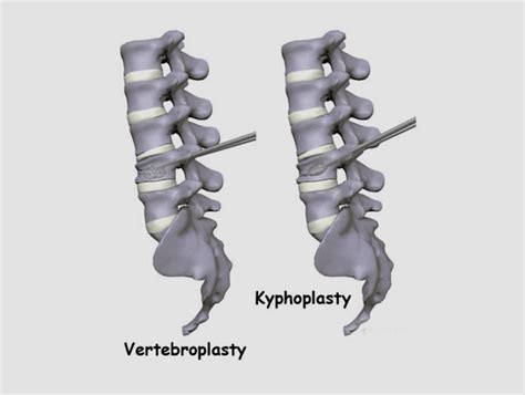 Vertebroplasty Vs Kyphoplasty