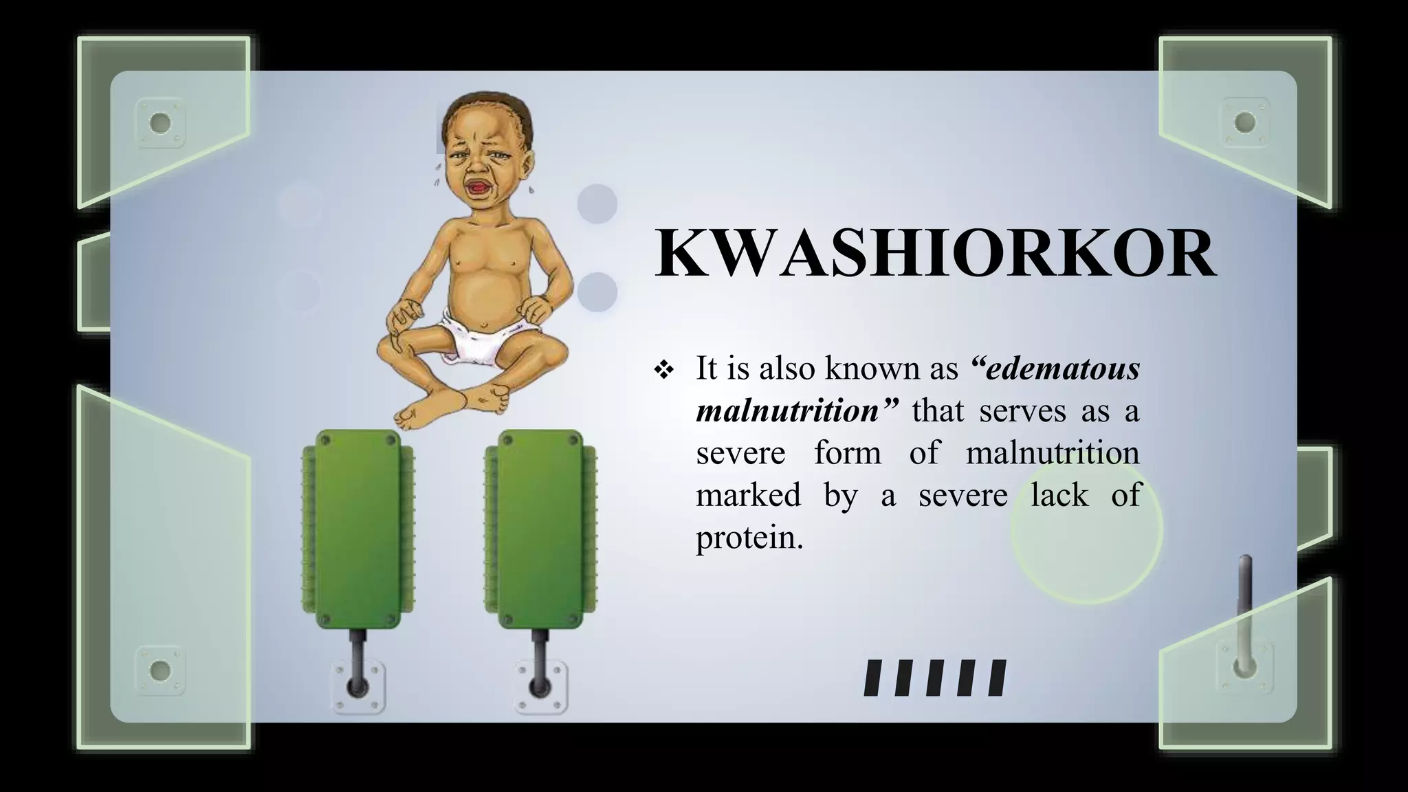 What Age Does Kwashiorkor Affect Understanding The Vulnerability Window
