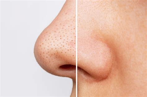 What Are Black Heads