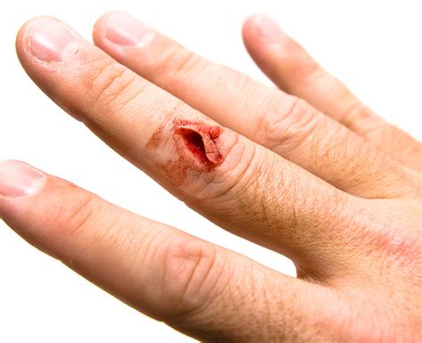 What Are Lacerations